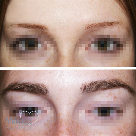 eyebrow hair transplant medco healthco stay safe  healthy