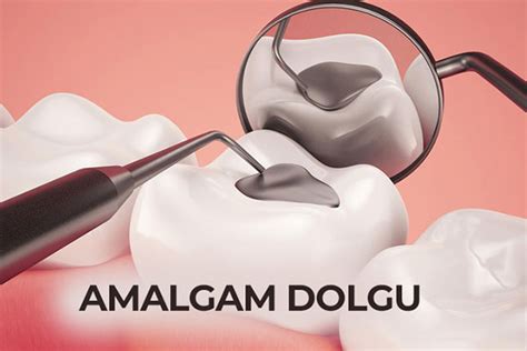 amalgam filling