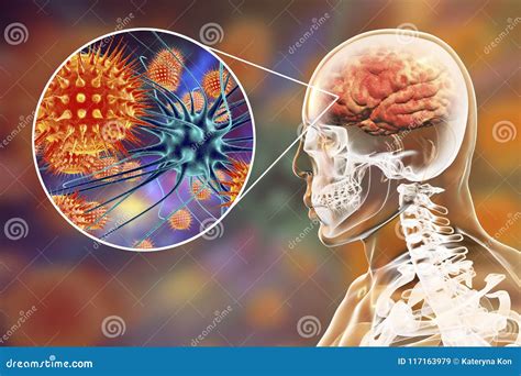 Viral Meningitis