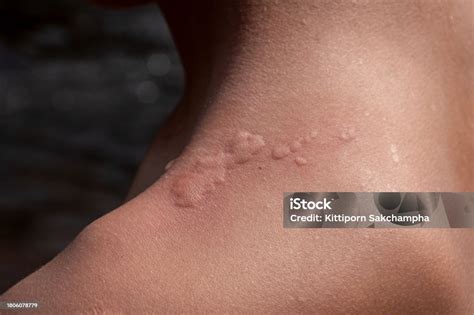 Rash Caused By Insect Bites On Skin Shoulder Itchy Rash Caused By Water ...