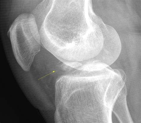 radiopaedia case tibial spine fracture id  study  nc commons