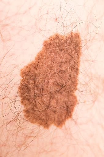 tanda kecantikan angioma melanoma foto stok  gambar