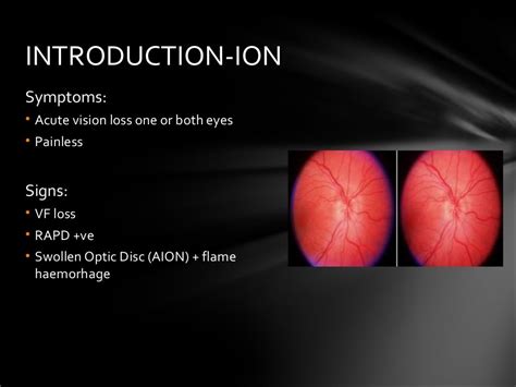 AION Anterior Ischemic Optic Neuropathy