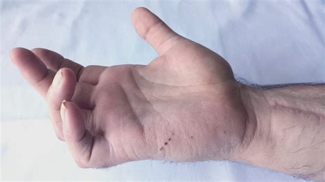 Grifa Ulnara in paralizia de nerv ulnar | Claw hand - YouTube
