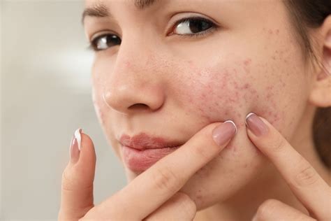 5 Different Causes of Hormonal Acne - Kine Magazine