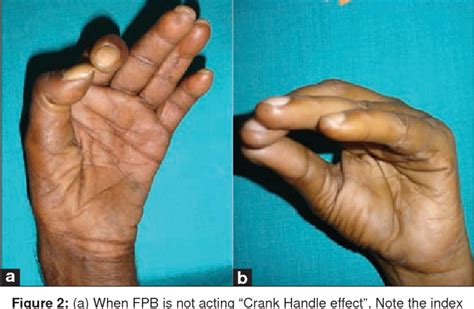 Figure 2 from Tendon transfer for median nerve palsy | Semantic Scholar