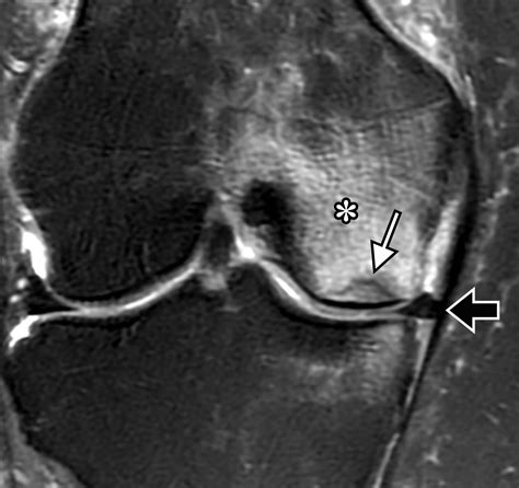 osteochondral lesions   knee differentiating   common