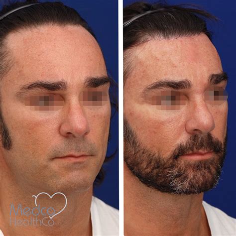 Forehead Reduction Surgery | Medco Healthco | Stay Safe and Healthy