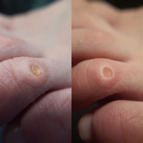 Best 13 How to Get Rid of Corns? – Artofit