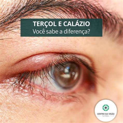 Calazio E Terçol Diferença - Você sabe a diferença entre terçol e calázio? - Centro da Visão Itumbiara