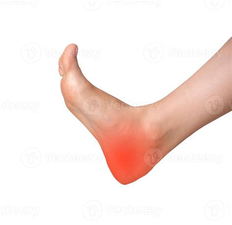 Foot pain with inflamed joint. Heel injury or strain with symptoms of