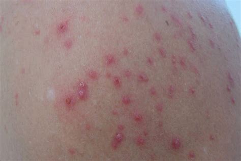 Coceira E Bolinhas No Corpo