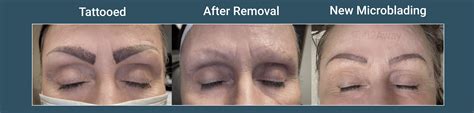 quality face tattoo removal services  tattaway