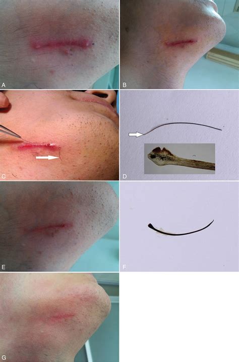 Ingrown Hair Pictures