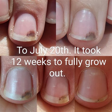 Healing of a bruised finger : r/MedicalGore