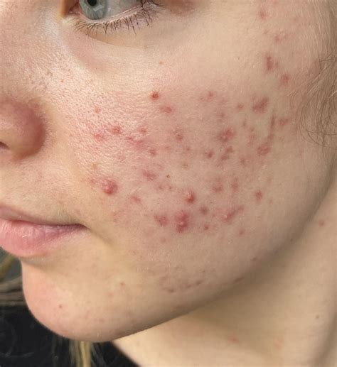 Hormonal acne, help! : r/acne