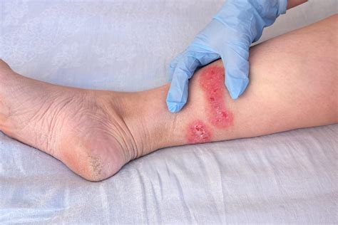 How To Heal Recurring Diabetic Sores On Legs With Amniotic Allografts