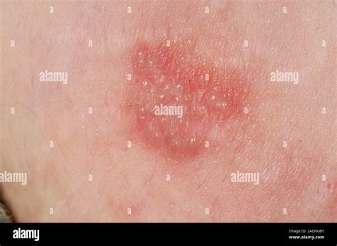 herpes simplex vesicles