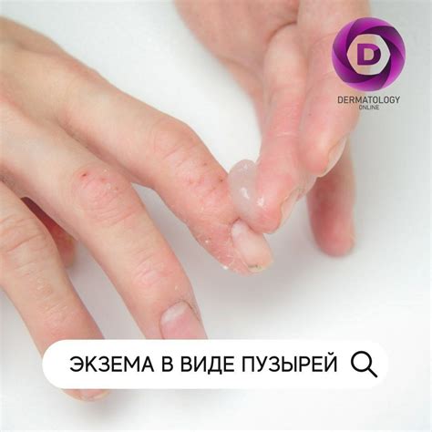 Экзема в виде пузырей, причины, лечение, консультация