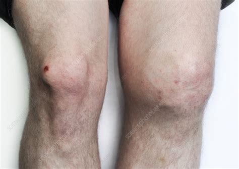 osteoarthritis   left knee stock image  science