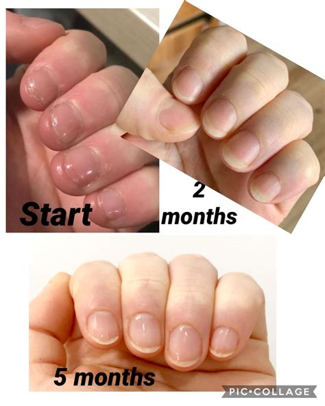 Does The Nail Bed Regrow at Leah Crisp blog