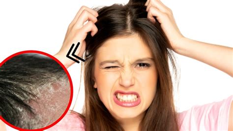 causas de la comezon en el cuero cabelludo  solo es caspa salud