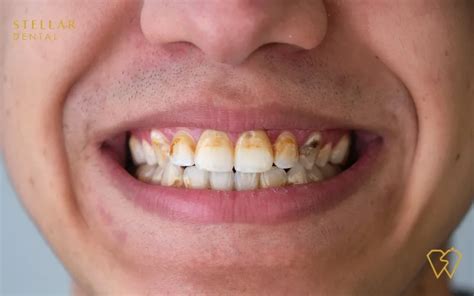 Plaque Tartar And How To Remove Them At Home, 49% OFF