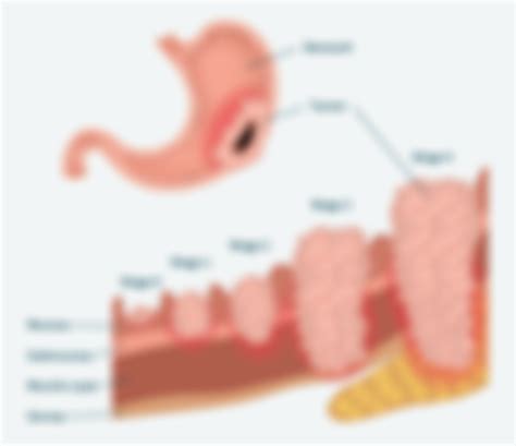 What Is Stomach (Gastric) Cancer? | OurCancerStories