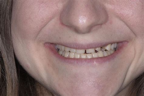 caso studio faccette dentali chiara studio odontoiatrico del malvo