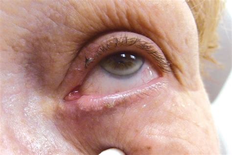 Eyelid Lumps and Bumps - Desert Doctors