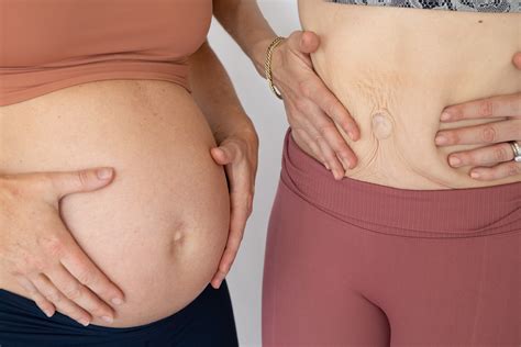 Rectus Diastasis - Exercises to Heal Stomach Separation After Birth
