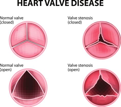 Heart Valve Expansion at Scarlett Packham blog