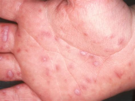 measles rash pictures   signs