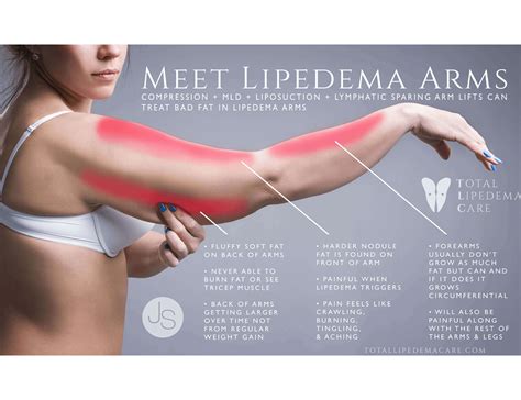 Resource Materials | Total Lipedema Care