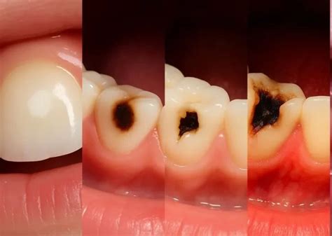 Dente Com Cárie Doendo O Que Fazer - Fotos de Cárie no Dente em diferentes fases e Como Tratar