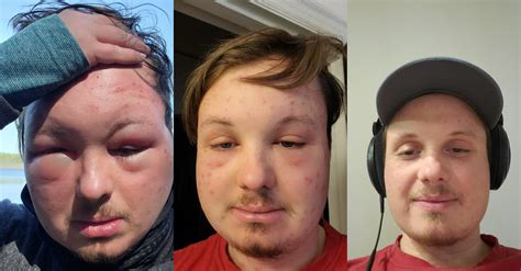 Face swelling reduction of 3 days : r/mildlyinteresting