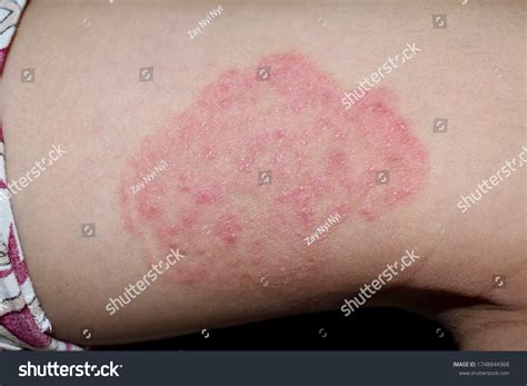 tinea corporis fungal infection  thigh stock photo