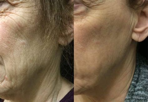 Microagulhamento Antes E Depois Rugas - Resultados de microagulhamento antes e depois com fotos – diaminyaesthetics