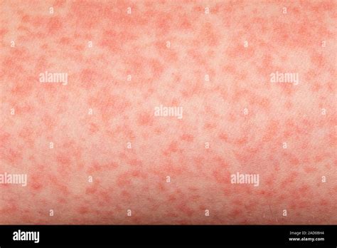 scarlet fever close    rash   skin    year  female
