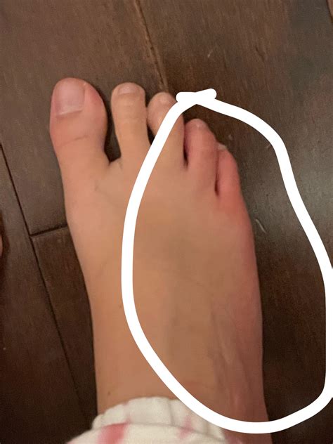 What is this redness on my pinky toe? : r/ChronicIllness
