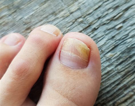 Nail Abnormalities - Part 2 (Koilonychia, Clubbing & Onycholysis) - The