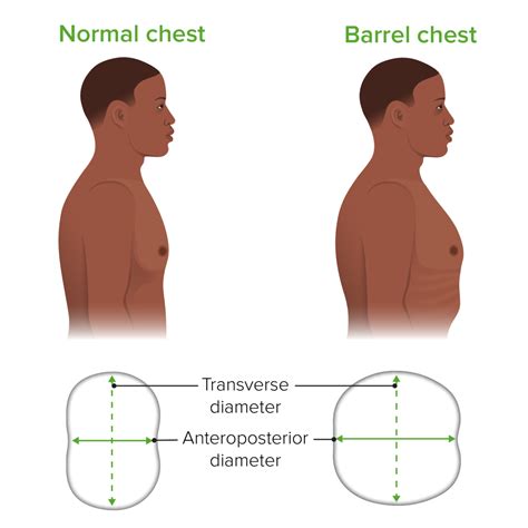 barrel chest emphysema  mary bevis blog