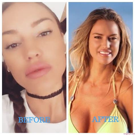Joan Kennedy Plastic Surgery Photos [Before & After] - Surgery4