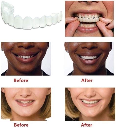 Provisional Denture Set - DIY Teeth Veneers & Tooth Bleaching for Men