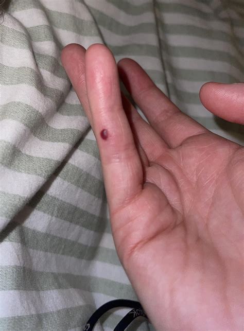(21F) Weird mole/birthmark type thing appeared on finger only today