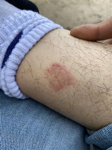 unknown red splotch rmedical