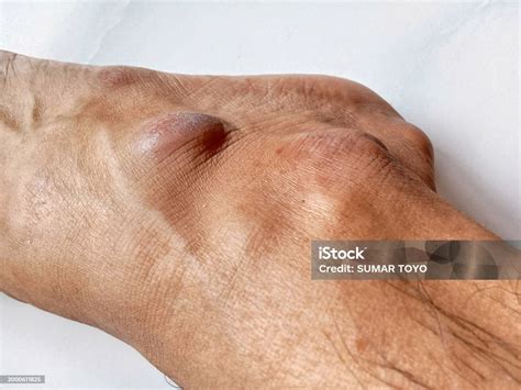 Lump On The Leg Stock Photo - Download Image Now - Bumpy, Human Foot ...