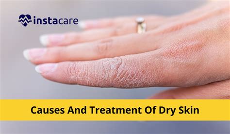 dry skin  prevention severe dry skin  remedies