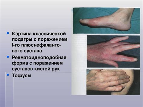 Подагра