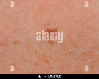 close    junctional naevus mole   skin    year